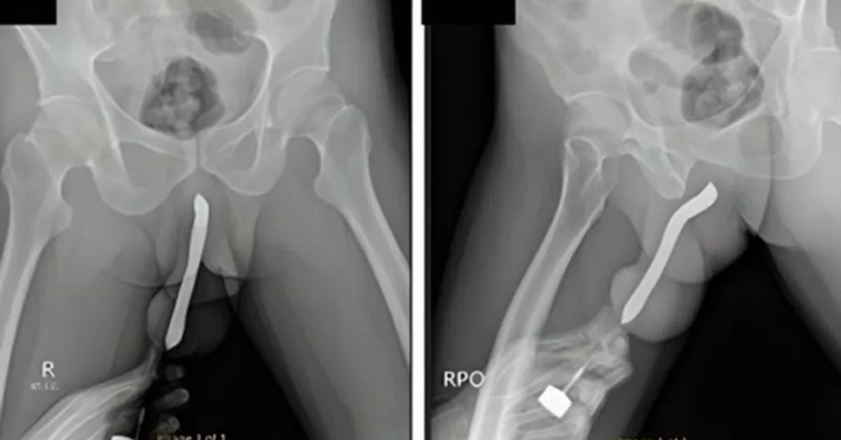 O homem surpreendeu os médicos quando chegou até a unidade de saúde com sintomas de dor, inchaço e hematomas. Mais detalhes foram expostos.